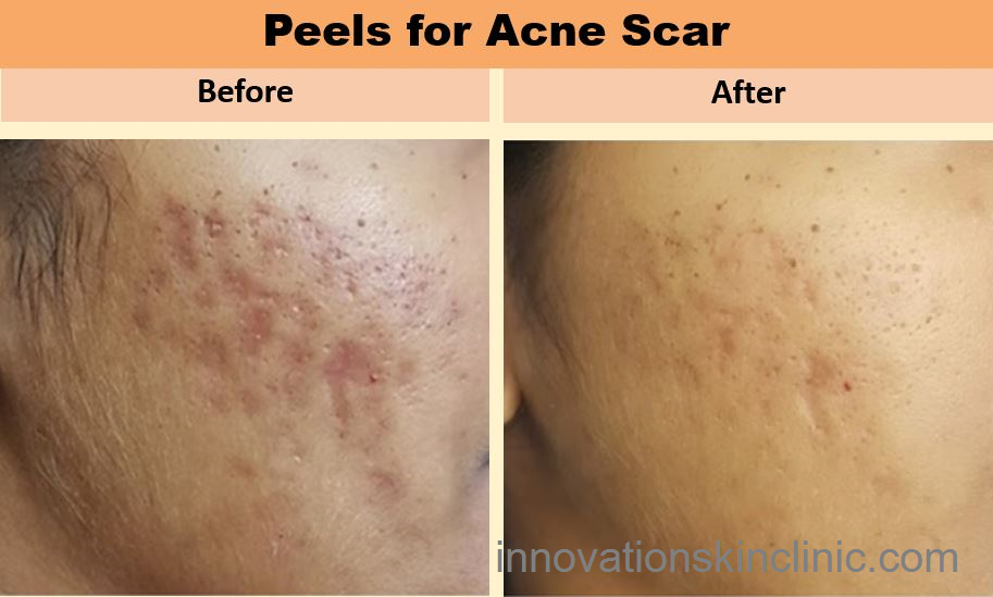 Acne Scars 2